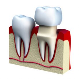 Dental Crown Mesa AZ