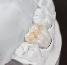 dental-inlay-onlay dental inlay-onlay cast
