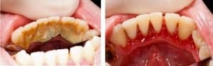 gum-disease-tartar-bacteria-build-up