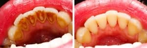 teeth cleaning before and after