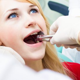 Tooth Extraction Mesa