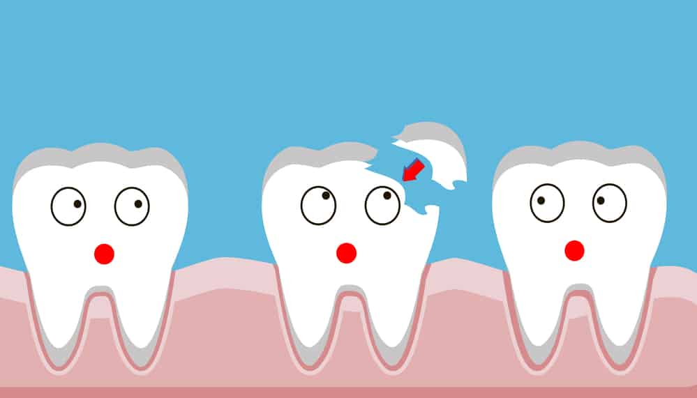 What To Do If You Chip Your Tooth Dental Brothers