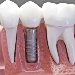 Capped Implant Model Dental Implants