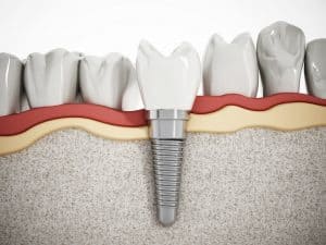 Choose Dental Implants